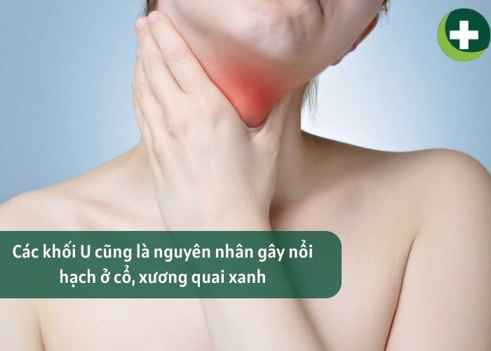 Các khối U cũng là nguyên nhân gây nổi hạch ở cổ, xương quai xanh