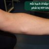 Nổi hạch ở bắp tay có phải bị HIV không?