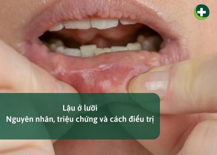 Lậu ở lưỡi: Nguyên nhân, triệu chứng và cách điều trị