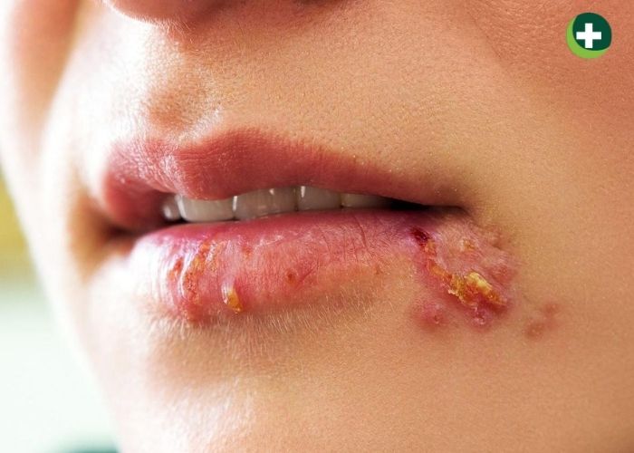 Các triệu chứng viêm loét ở môi miệng khi bị giang mai