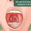 Đau họng họng hiv là gì có nguy hiểm không
