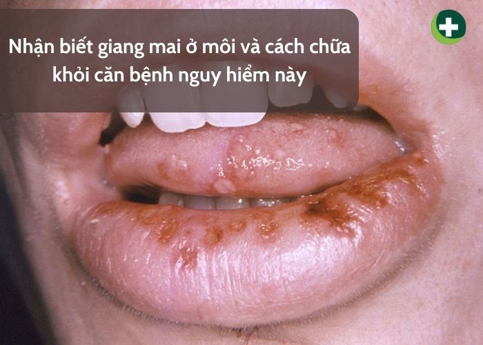 Tìm hiểu về bệnh giang mai ở môi và miệng